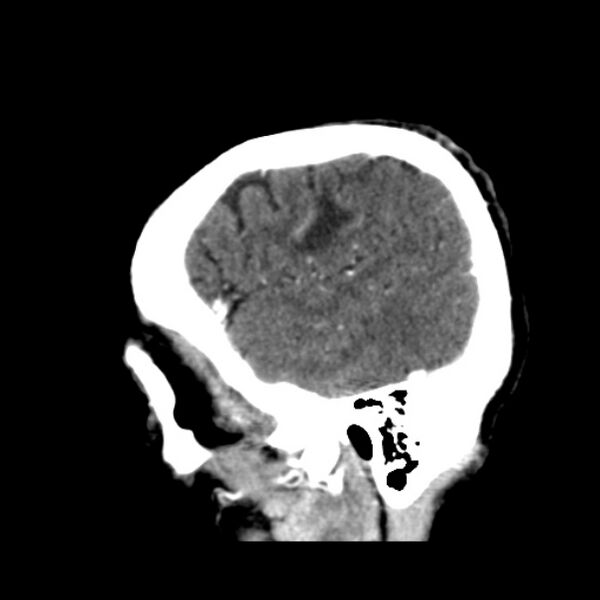 File:Brain metastases from lung cancer (Radiopaedia 24480-24781 C+ delayed 10).jpg