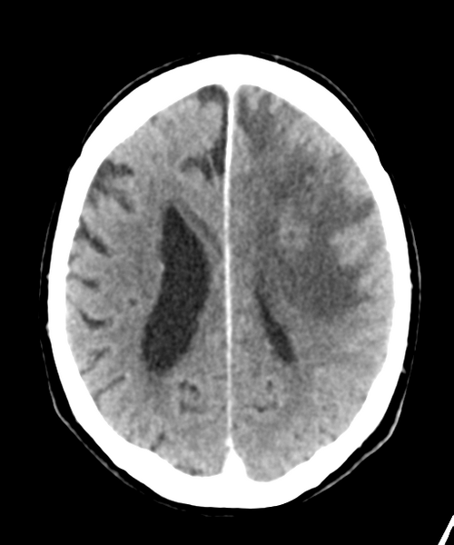 File:Brain metastasis (lung cancer) (Radiopaedia 48289-53177 Axial C+ 21).png
