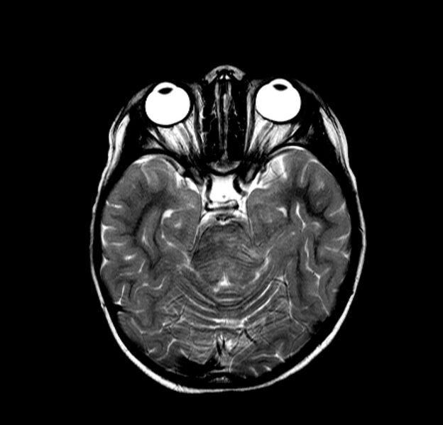 File:Brainstem glioma (Radiopaedia 5683-7390 Axial T2 5).jpg