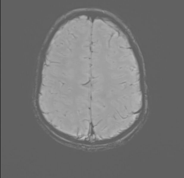 File:Brainstem glioma (Radiopaedia 70548-80674 Axial SWI 50).jpg