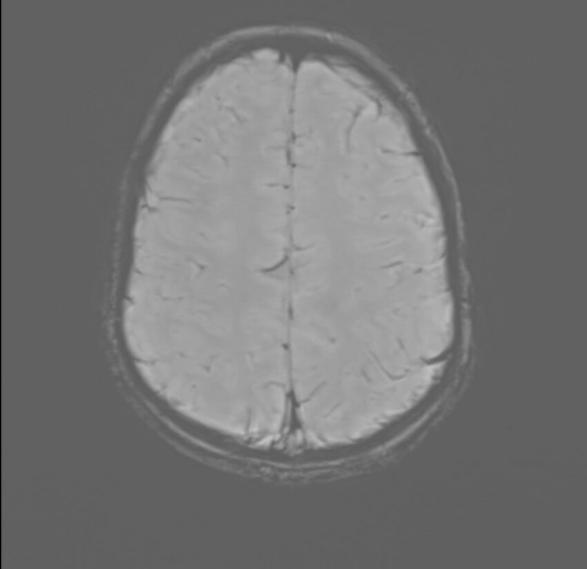 Brainstem glioma (Radiopaedia 70548-80674 Axial SWI 50).jpg