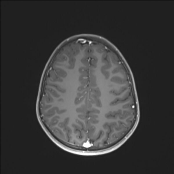 File:Brainstem glioma (Radiopaedia 70548-80674 Axial T1 C+ 114).jpg