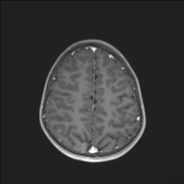 File:Brainstem glioma (Radiopaedia 70548-80674 Axial T1 C+ 120).jpg