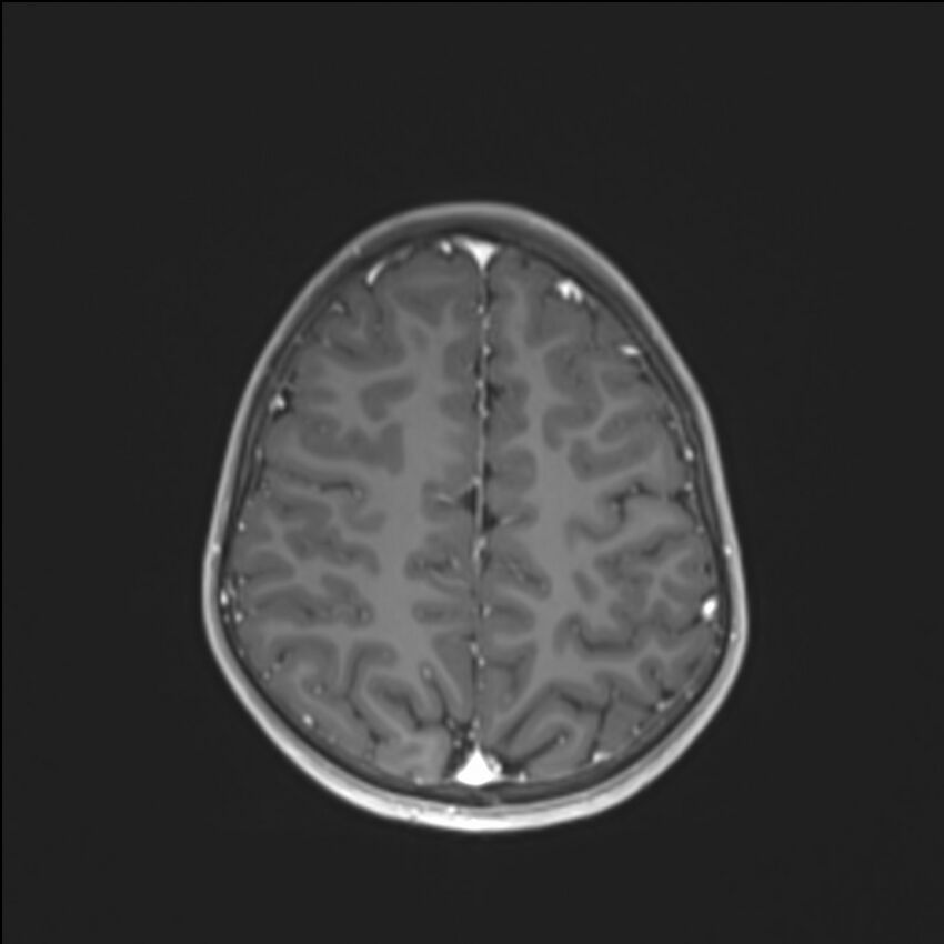 Brainstem glioma (Radiopaedia 70548-80674 Axial T1 C+ 120).jpg