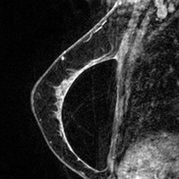 File:Breast implants - MRI (Radiopaedia 26864-27035 Sagittal T2 95).jpg