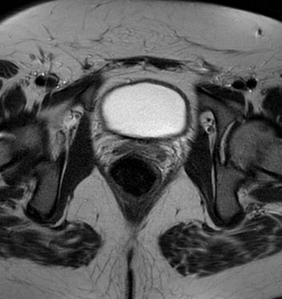 File:Broad ligament leiomyoma (Radiopaedia 81634-95516 Axial T2 22).jpg