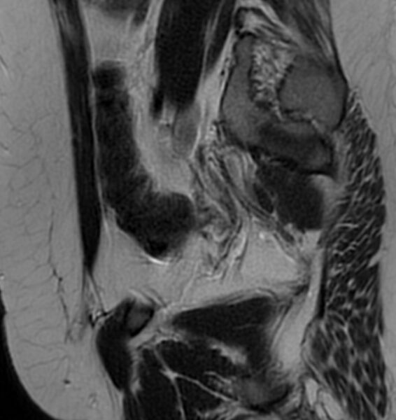 File:Broad ligament leiomyoma (Radiopaedia 81634-95516 Sagittal T2 23).jpg