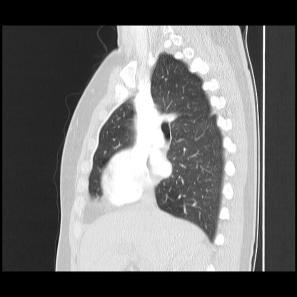File:Bronchial atresia (Radiopaedia 22965-22992 Sagittal lung window 33).jpg