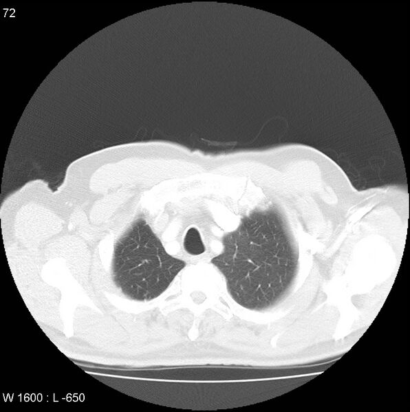 File:Bronchial carcinoid tumor with right lower lobe collapse (Radiopaedia 29060-29422 B 10).jpg