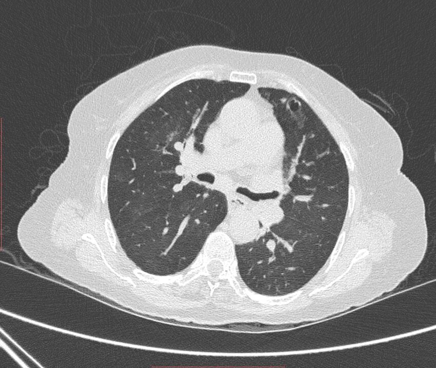 Bronchiectasis (Radiopaedia 72693-83293 Axial lung window 57).jpg