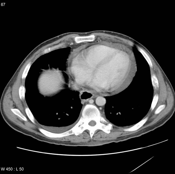 File:Bronchogenic carcinoma (Radiopaedia 8857-9645 A 12).jpg