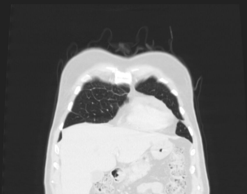 Bronchogenic carcinoma with lymphangitic spread (Radiopaedia 29002-29357 Coronal lung window 6).jpg