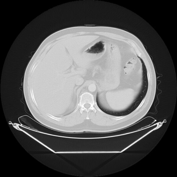 File:Bronchogenic carcinoma with upper lobe collapse (Radiopaedia 29297-29726 Axial lung window 31).jpg