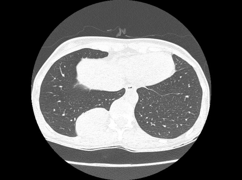 File:Bronchogenic cyst (Radiopaedia 80273-93615 Axial lung window 20).jpg