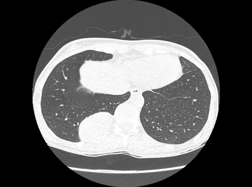 Bronchogenic cyst (Radiopaedia 80273-93615 Axial lung window 20).jpg