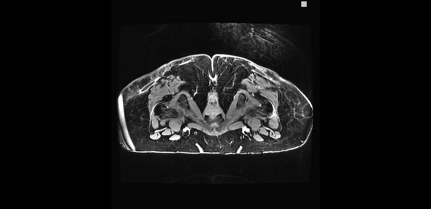 Buttock filler complications (Radiopaedia 63497-72115 Axial T1 C+ 41).jpg
