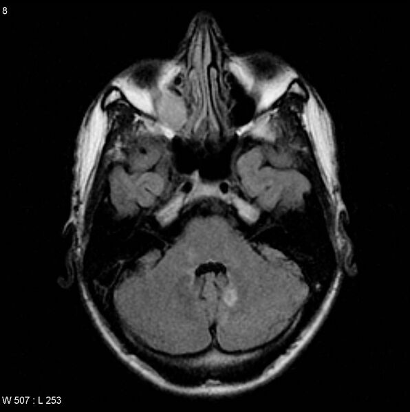 File:CMV ventriculitis and encephalitis (Radiopaedia 5416-7166 Axial FLAIR 1).jpg