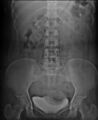 Calcified fibroid (Radiopaedia 16272-15952 B 1).jpg