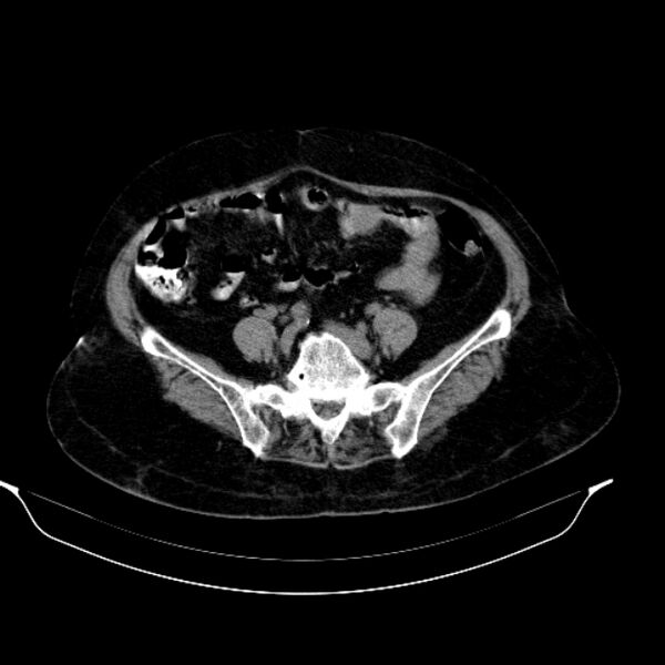 File:Calcified hydatid cyst (Radiopaedia 62000-70085 Axial non-contrast 77).jpg