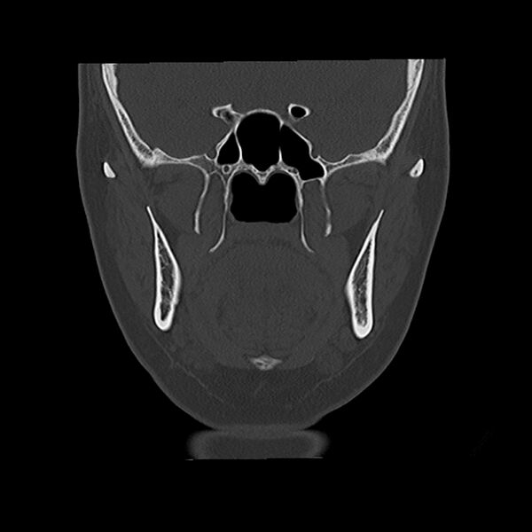 File:Canal up mastoidectomy (Radiopaedia 78108-90638 Coronal bone window 19).jpg