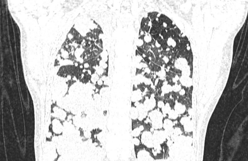 File:Cannonball metastases from breast cancer (Radiopaedia 91024-108569 Coronal lung window 110).jpg