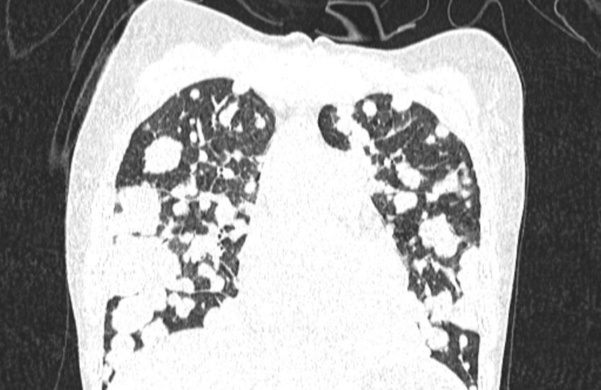 Cannonball metastases from breast cancer (Radiopaedia 91024-108569 Coronal lung window 51).jpg
