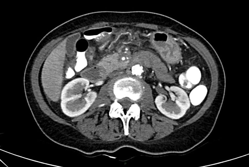 File:Carcinoid mesenteric tumor complicated by chylous ascites (Radiopaedia 76312-88926 A 31).jpg