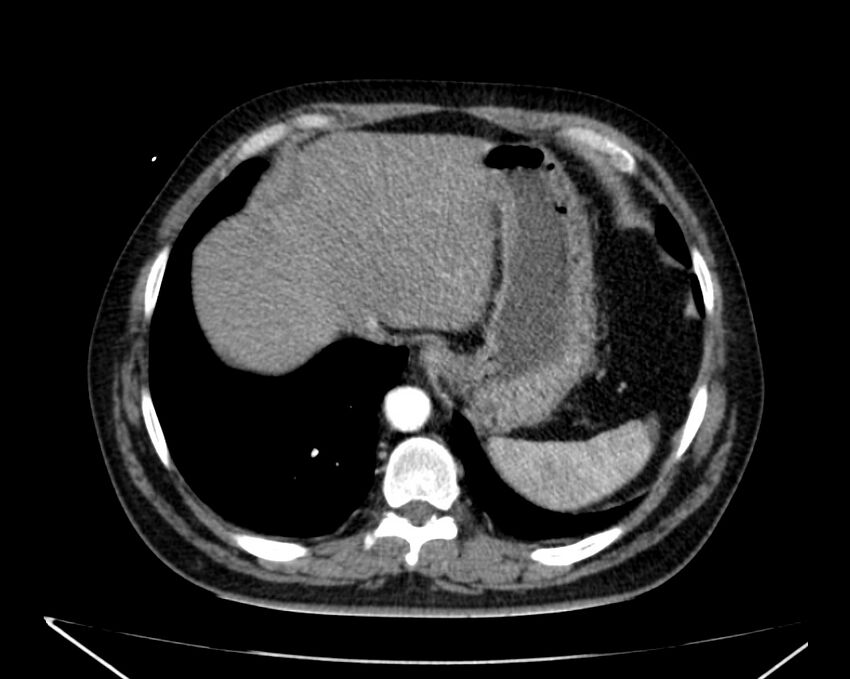 Carcinoid tumor with hepatic metastases (Radiopaedia 22651-22670 B 12).jpg