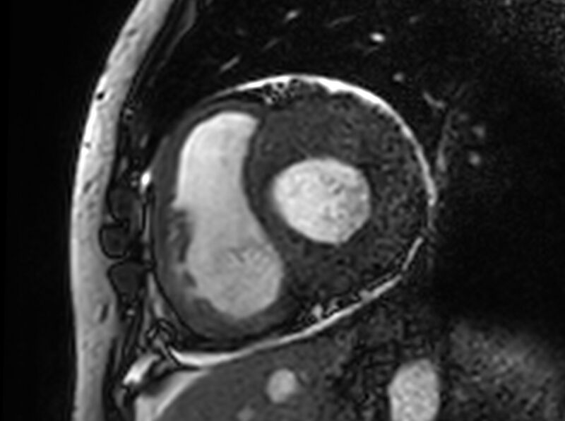 File:Cardiac amyloidosis (Radiopaedia 61600-69579 Short axis bSSFP 252).jpg