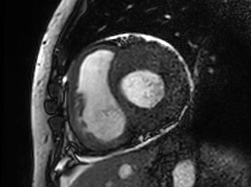 Cardiac amyloidosis (Radiopaedia 61600-69579 Short axis bSSFP 252).jpg