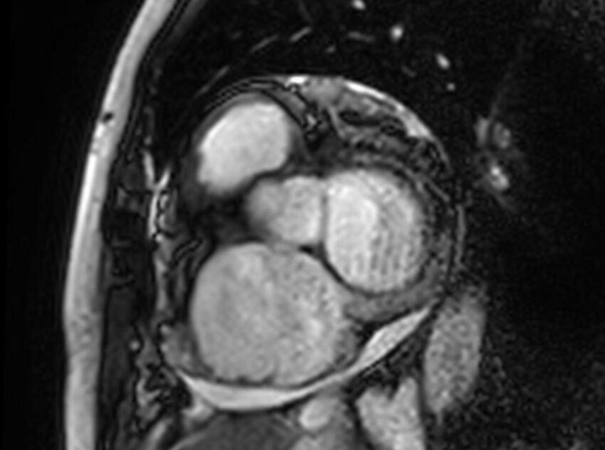 Cardiac amyloidosis (Radiopaedia 61600-69579 Short axis bSSFP 324).jpg