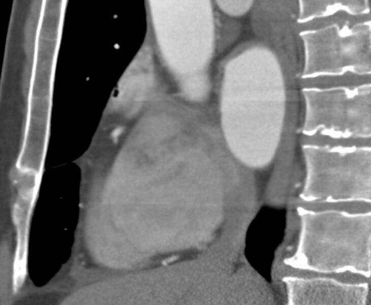 File:Cardiac hemangioma (Radiopaedia 16971-16679 C 16).JPG