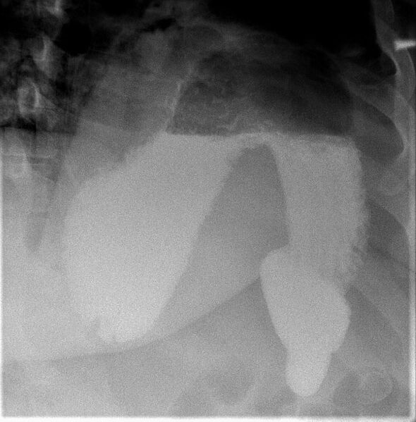 File:Cascade stomach (Radiopaedia 89762-106852 Upright frontal 1).JPG