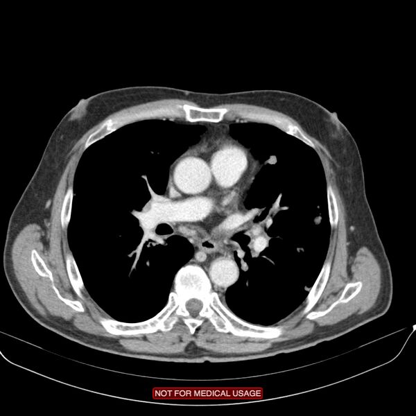 File:Cavitating pulmonary metastases (Radiopaedia 24920-25184 B 13).jpg
