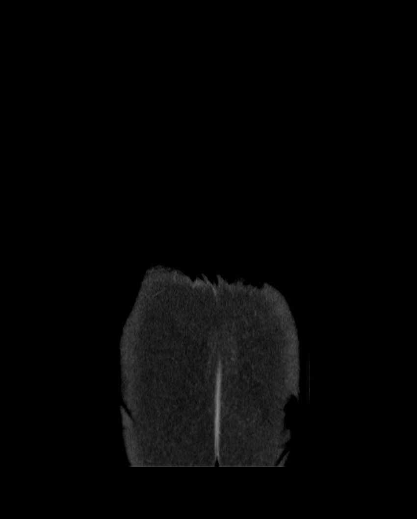 Cecal volvulus (Radiopaedia 54998-61310 B 66).jpg