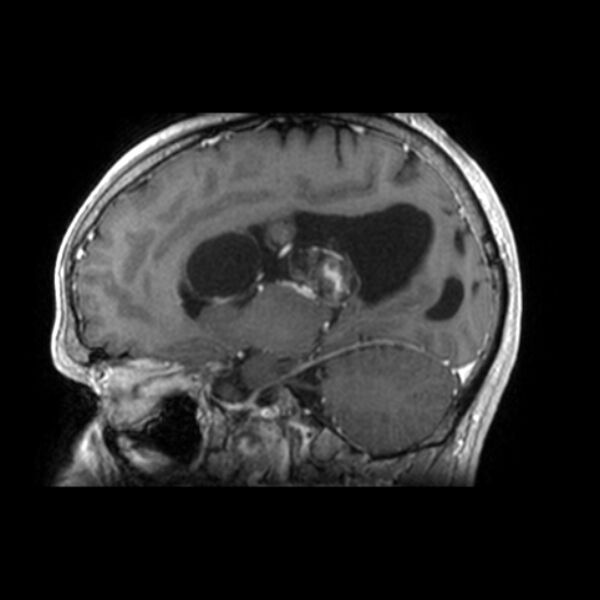 File:Central neurocytoma (Radiopaedia 67618-77021 Sagittal T1 C+ 18).jpg