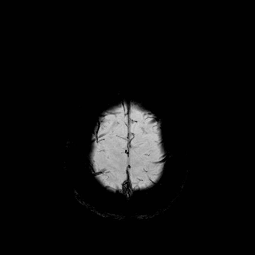 Central neurocytoma (Radiopaedia 79320-92380 Axial SWI 128).jpg