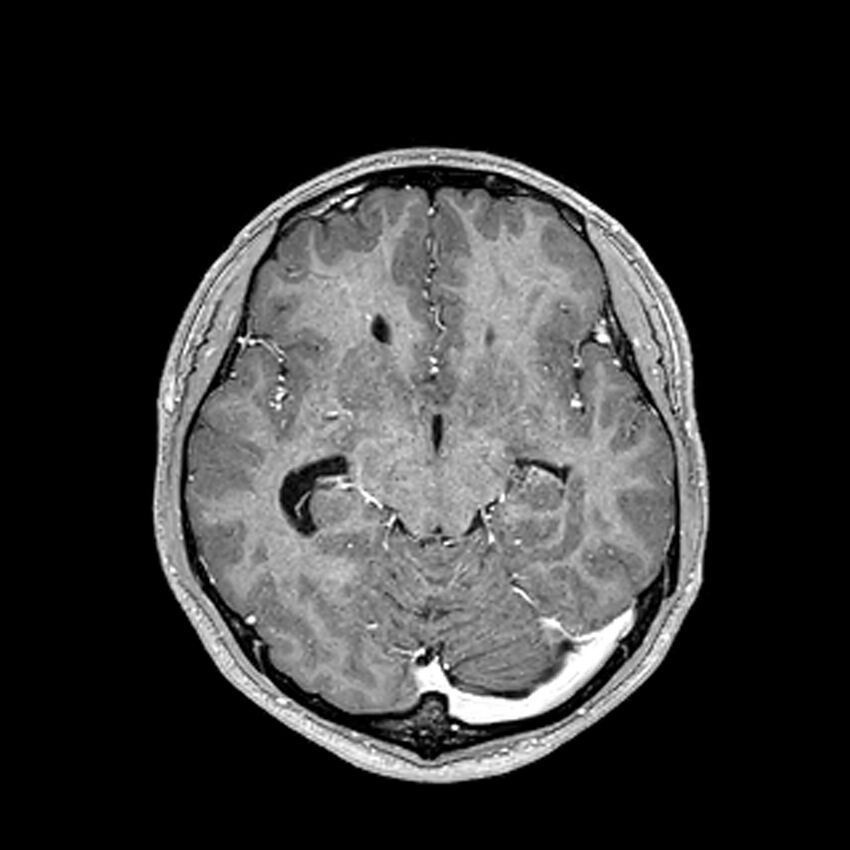 Central neurocytoma (Radiopaedia 79320-92380 Axial T1 C+ 108).jpg