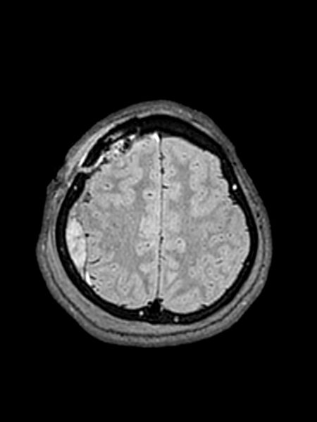 File:Central neurocytoma (Radiopaedia 79320-92381 Axial FLAIR 46).jpg