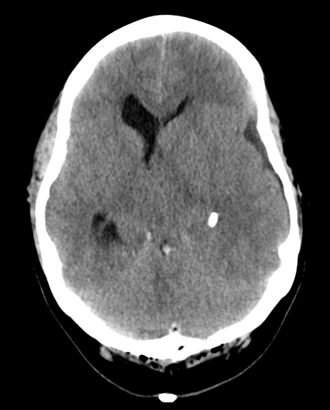 File:Cerebellar ependymoma complicated by post-operative subdural hematoma (Radiopaedia 83322-97737 Axial non-contrast 18).png
