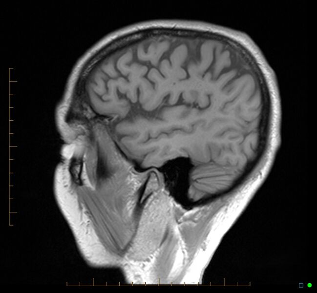 File:Cerebellar gangliocytoma (Radiopaedia 65377-74422 Sagittal T1 7).jpg