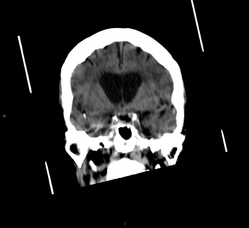 Cerebellar hemorrhage (Radiopaedia 58792-66026 Coronal non-contrast 40).jpg