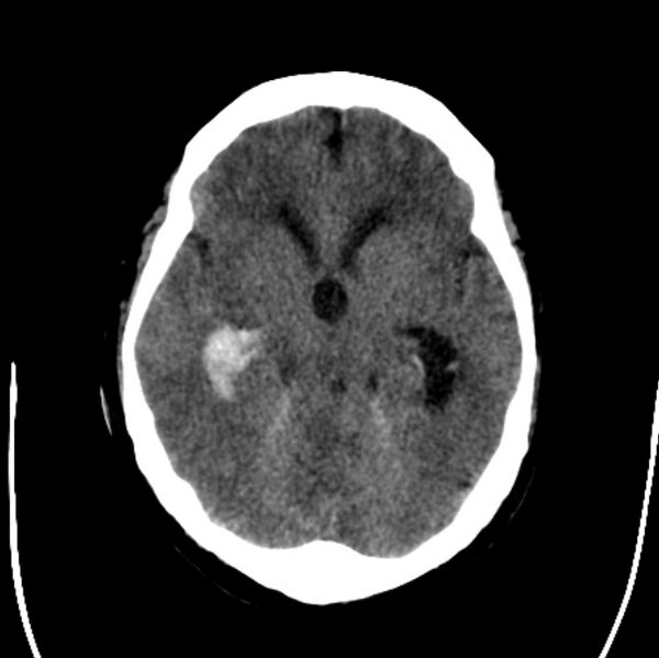 File:Cerebellar hemorrhage causing obstructive hydrocephalus (Radiopaedia 33989-35207 Axial non-contrast 20).jpg