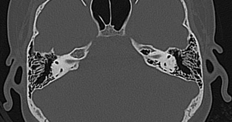 File:Cerebellopontine angle lipoma (Radiopaedia 57303-64242 Axial bone window 36).jpg