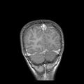 Cerebral abscess post cardiac surgery (Radiopaedia 27244-27420 Coronal T1 C+ 21).jpg