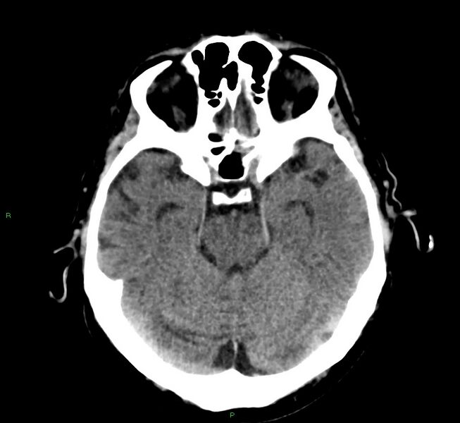 File:Cerebral amyloid angiopathy-associated lobar intracerebral hemorrhage (Radiopaedia 58376-65511 Axial non-contrast 38).jpg