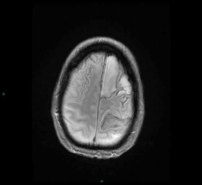 File:Cerebral amyloid angiopathy-associated lobar intracerebral hemorrhage (Radiopaedia 58529-65684 Axial Gradient Echo 22).jpg