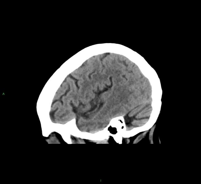 File:Cerebral amyloid angiopathy-associated lobar intracerebral hemorrhage (Radiopaedia 58563-65727 C 41).jpg