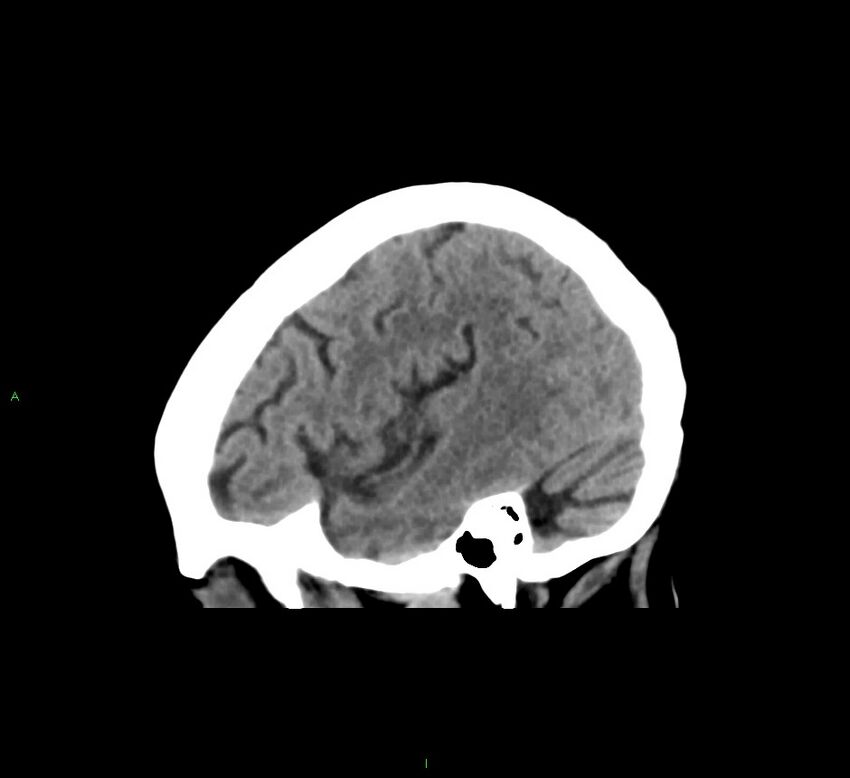 Cerebral amyloid angiopathy-associated lobar intracerebral hemorrhage (Radiopaedia 58563-65727 C 41).jpg