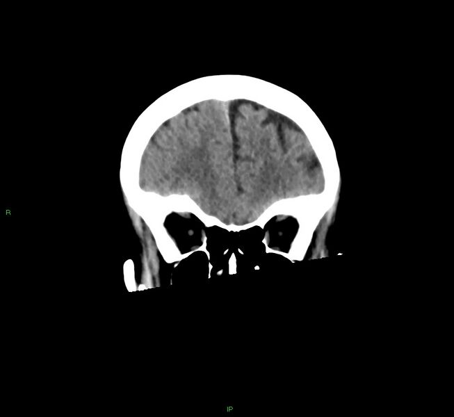 File:Cerebral amyloid angiopathy-associated lobar intracerebral hemorrhage (Radiopaedia 58563-65727 Coronal non-contrast 51).jpg